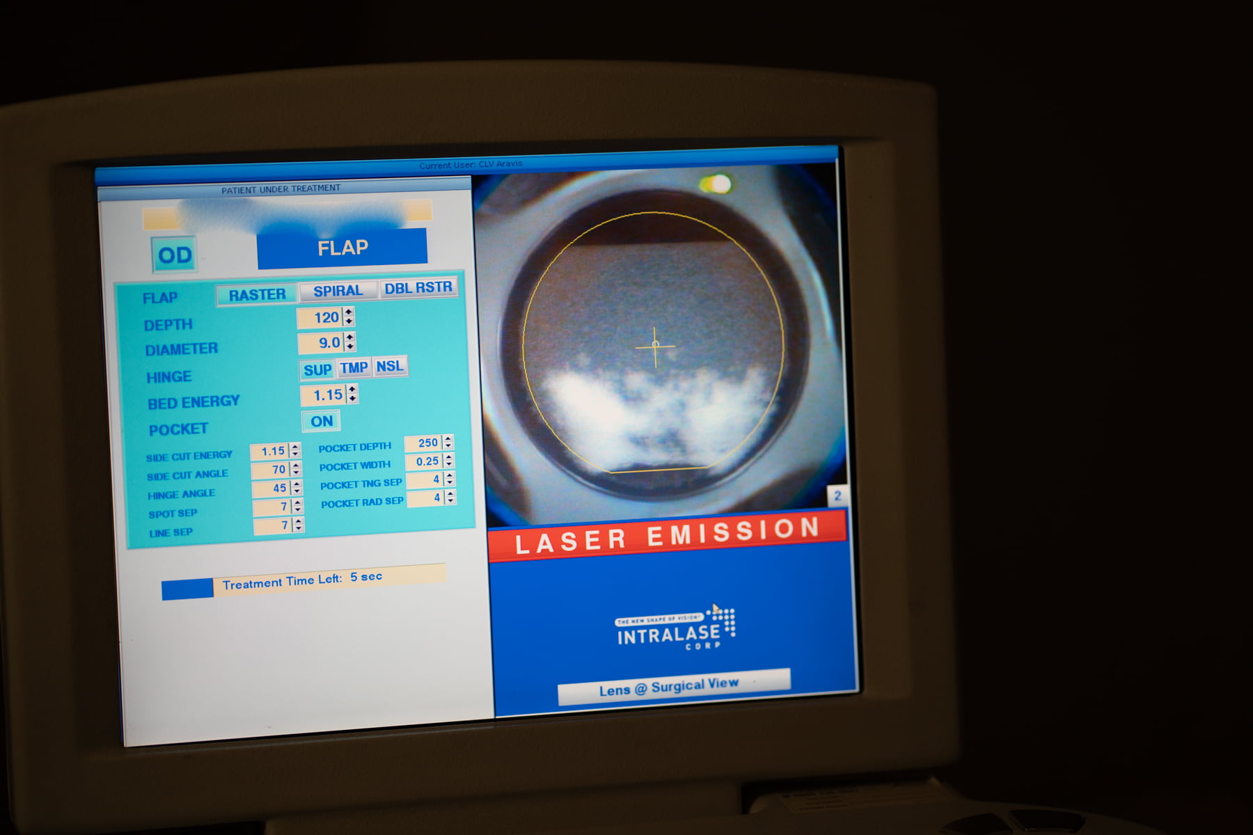Annecy Laser Vision Salle de Chirurgie LASIK PKR PKT